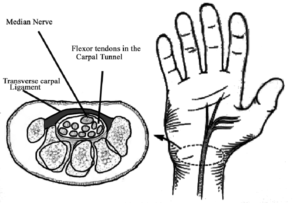Carpal Tunnel Syndrome Symptoms and Treatment Canberra Hand Centre