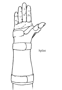 dequervain-splint