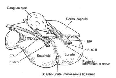 ganglion-treatment